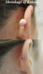 earlobe keloid removal