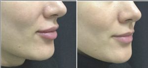 lip enhancement augmentation in san antonio before after 