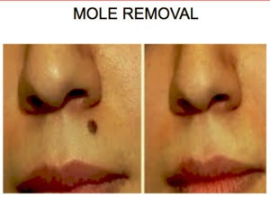 MOLE REMOVAL in San antonio BEFORE AFTER