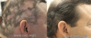 before after alopecia san antonio boerne 