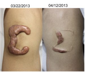 keloid in san antonio Before After Arm